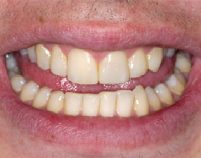 After - Hilltop Dental