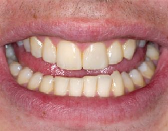 After - Lenham Dental