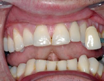 After - Lenham Dental