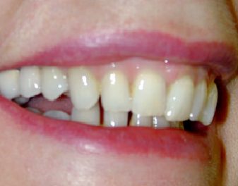 After - Lenham Dental
