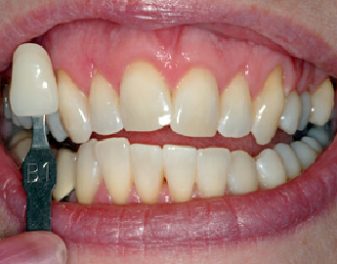 After - Lenham Dental