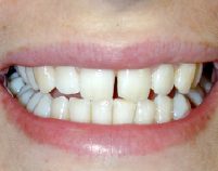 Before - Hilltop Dental