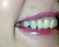 Before - Hilltop Dental