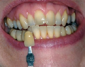 Before - Lenham Dental