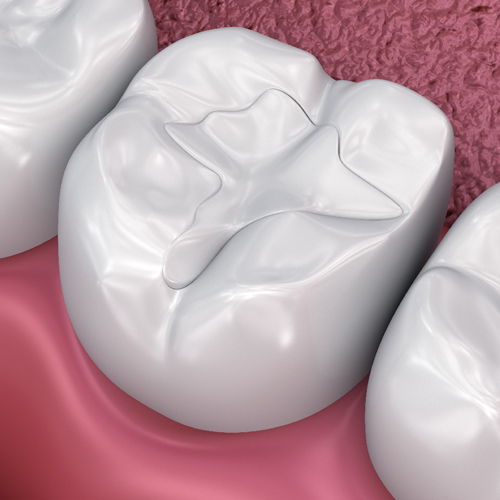 Dentists Birmingham White Fillings in Northfield, Birmingham