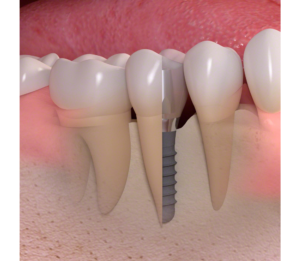 Dental implants