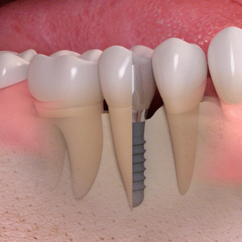 Dental implants 
